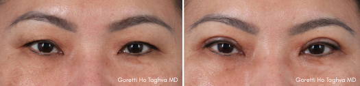 Upper Blepharoplasty Before & After - Dr. Taghva
