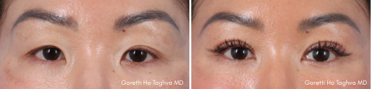 Upper Blepharoplasty & Medial Epicanthoplasty B & A - Dr. Taghva