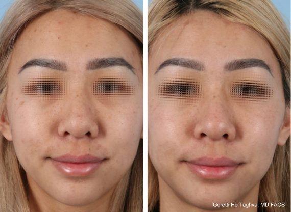 BBL Moxi Before & After