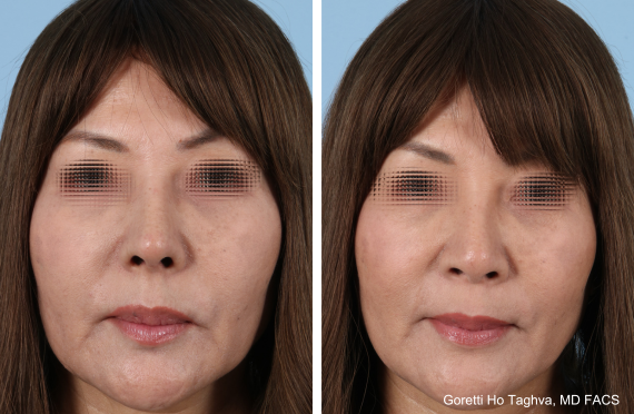 Rhinoplasty Before & Afters