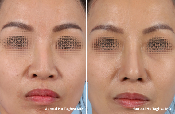 Revision Rhinoplasty Before & After