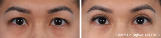 Secondary Upper Blepharoplasty and Lower Blepharoplasty Before & Afters
