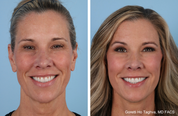 Deep Plane Facelift and Fat Transfer Before & After
