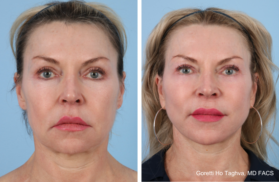 Deep Plane Facelift, Lower Blepharoplasty and Fat Transfer Before & After