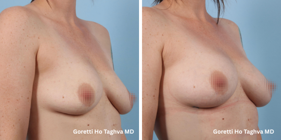 Fat Transfer to Breast Before & After