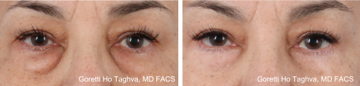 Lower Blepharoplasty Before & After