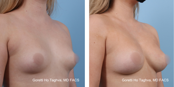 Fat Transfer to Breast Before & After