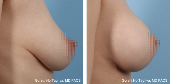 Breast Lift with Augmentation Before & After