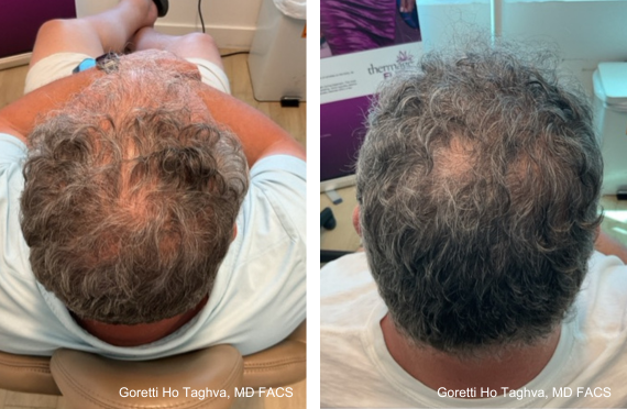 FoLix Before and After