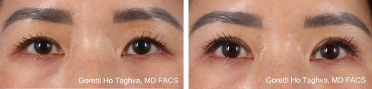 Upper Blepharoplasty Before & After Images