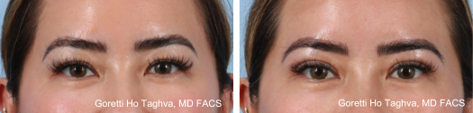 Upper Blepharoplasty Before & After