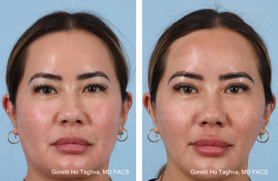 Upper Bleaharoplasty, Liposculpting Lower Face, Submental Area & Renuvion Before & Afters