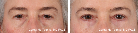 Upper and Lower Blepharoplasty Before & Afters