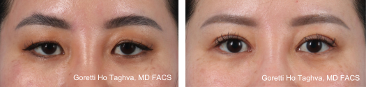 Upper Blepharoplasty & Medial Epicanthoplasty Before & After