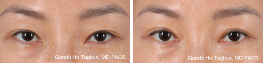 Upper Blepharoplasty & Medial Epicanthoplasty Before & After