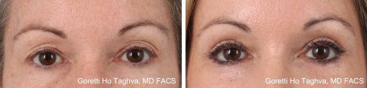 Upper & Lower Blepharoplasty Before & After Images
