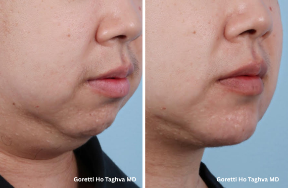 Submental liposuction + Renuvion submental skin tightening + Chin Augmentation with chin implant Before & After