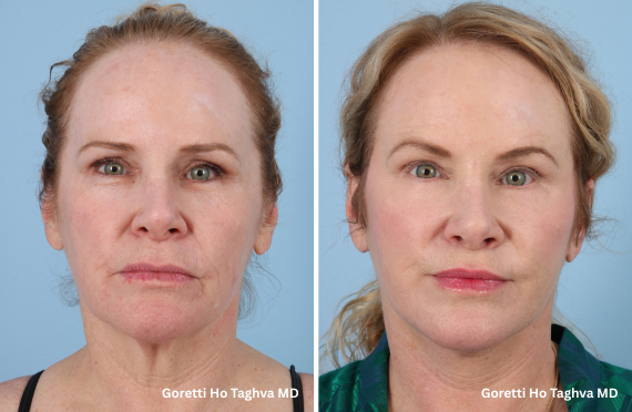 Deep Plane Facelift, Upper Lip Lift and Lower Blepharoplasty Before & Afters