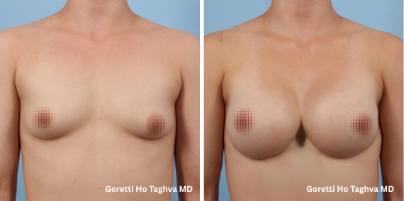 Endoscopic Transaxillary Breast Augmentation Before & After