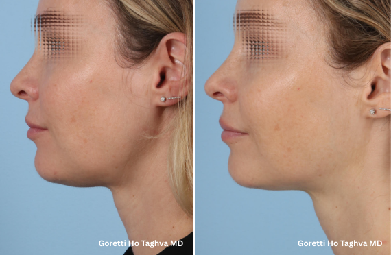 Ultherapy Prime Before & After Images