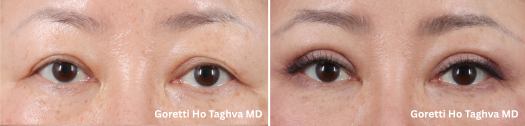 Upper Blepharoplasty Before & After Images
